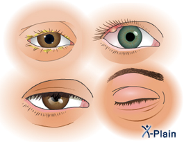 eyelid diseases