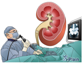 Ureteroscopy with Laser Lithotripsy