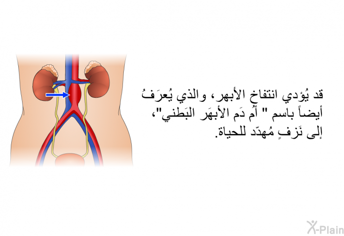 قد يُؤدي انتفاخ الأبهر، والذي يُعرَفُ أيضاً باسم " أُم دَم الأبهَر البَطني"، إلى نَزفٍ مُهدّد للحياة.