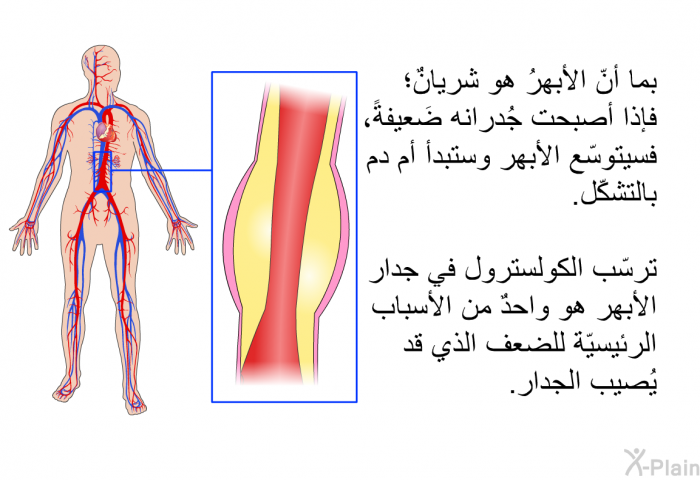 بما أنّ الأبهرُ هو شريانٌ؛ فإذا أصبحت جُدرانه ضَعيفةً، فسيتوسّع الأبهر وستبدأ أم دم بالتشكّل. ترسّب الكولسترول في جدار الأبهر هو واحدٌ من الأسباب الرئيسيّة للضعف الذي قد يُصيب الجدار.