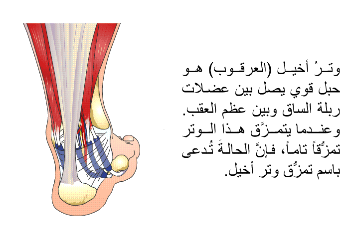 وترُ أخيل (العرقوب) هو حبل قوي يصل بين عضلات ربلة الساق وبين عظم العقب. وعندما يتمزَّق هذا الوترُ تمزُّقاً تاماً، فإنَّ الحالةَ تُدعى باسم تمزُّق وتر أخيل.