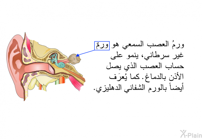 ورمُ العصب السمعي هو ورمٌ غير سرطاني، ينمو على حساب العصب الذي يصل الأذن بالدماغ. كما يُعرَف أيضاً بالورم الشفاني الدهليزي.