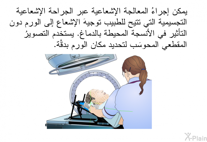 يمكن إجراءُ المعالجة الإشعاعية عبر الجراحة الإشعاعية التجسيمية التي تتيح للطبيب توجيهَ الإشعاع إلى الورم دون التأثير في الأنسجة المحيطة بالدماغ. يستخدم التصويرُ المقطعي المحوسَب لتحديد مكان الورم بدقَّة.