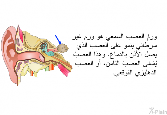 ورمُ العصب السمعي هو ورم غير سرطاني ينمو على العصب الذي يصل الأذن بالدماغ. وهذا العصبُ يُسَمَّى العصبَ الثامن، أو العصب الدهليزي القوقعي.