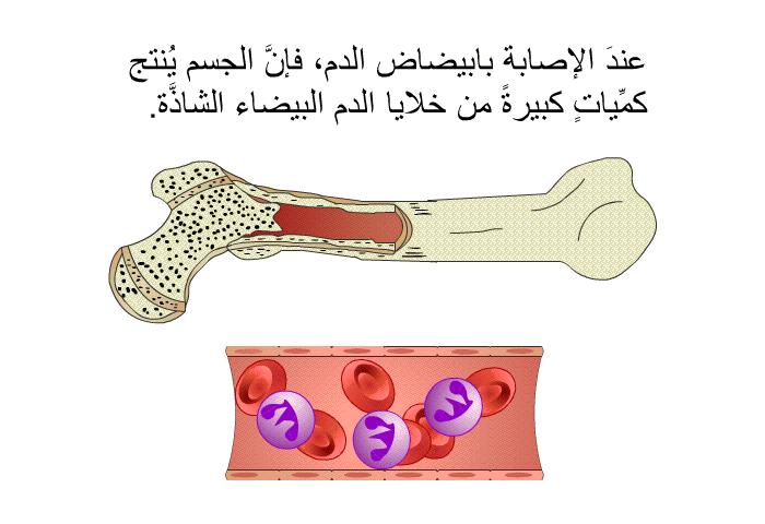 عندَ الإصابة بابيضاض الدم، فإنَّ الجسم يُنتج كمِّياتٍ كبيرةً من خلايا الدم البيضاء الشاذَّة.