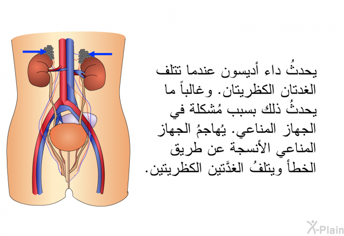 يحدثُ داء أديسون عندما تتلف الغدتان الكظريتان. وغالباً ما يحدثُ ذلك بسبب مُشكلة في الجهاز المناعي. يُهاجمُ الجهاز المناعي الأنسجة عن طريق الخطأ ويتلفُ الغدَّتين الكظريتين.