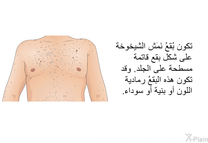 تكون بُقعُ نَمَش الشيخوخة على شكل بقع قاتمة مسطحة على الجلد. وقد تكون هذه البقعُ رمادية اللون أو بنية أو سوداء.