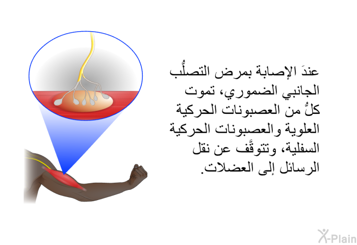 عندَ الإصابة بمرض التصلُّب الجانبي الضموري، تموت كلُّ من العصبونات الحركية العلوية والعصبونات الحركية السفلية، وتتوقَّف عن نقل الرسائل إلى العضلات.