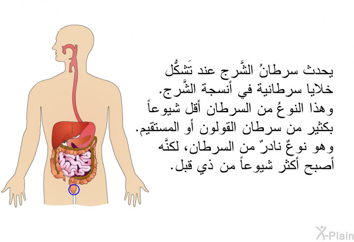 يحدث سرطانُ الشَّرج عند تَشكُّل خلايا سرطانية في أنسجة الشَّرج. وهذا النوعُ من السرطان أقل شيوعاً بكثير من سرطان القولون أو المستقيم. وهو نوعٌ نادرٌ من السرطان، لكنَّه أصبح أكثر شيوعاً من ذي قبل.