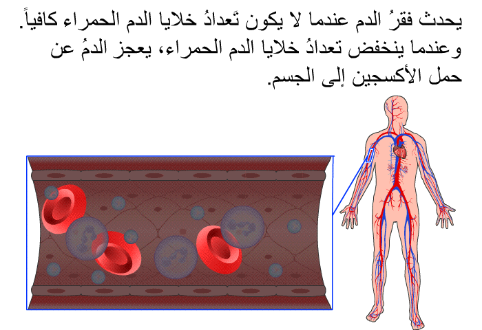 يحدث فقرُ الدم عندما لا يكون تَعدادُ خلايا الدم الحمراء كافياً. وعندما ينخفض تعدادُ خلايا الدم الحمراء، يعجز الدمُ عن حمل الأكسجين إلى الجسم.