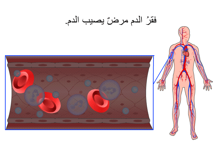 فقرُ الدم مرضٌ يصيب الدم.
