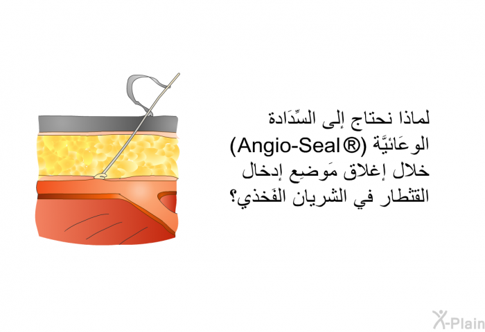 لماذا نحتاج إلى السِّدَادة الوِعَائيَّة <I>(</I>Angio-Seal <I>) </I>خلال إغلاق مَوضِع إدخال القثطار في الشريان الفَخذي؟