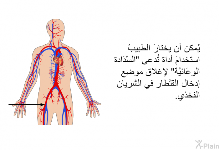 يُمكن أن يختارَ الطبيبُ استخدامَ أداة تُدعى "السِّدَادة الوِعَائيَّة" لإغلاق موضِع إدخال القثطَار في الشريان الفخذي.