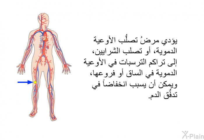 يؤدي مرضُ تصلُّب الأوعية الدموية، أو تصلب الشرايين، إلى تراكم الترسبات في الأوعية الدموية في الساق أو فروعها، ويمكن أن يسبب انخفاضاً في تدفُّق الدم.