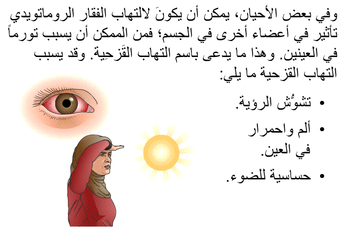 وفي بعض الأحيان، يمكن أن يكونَ لالتهاب الفقار الروماتويدي تأثير في أعضاء أخرى في الجسم؛ فمن الممكن أن يسبب تورماً في العينين. وهذا ما يدعى باسم التهاب القَزحِية. وقد يسبب التهاب القزحية ما يلي:  تشوُّش الرؤية. ألم واحمرار في العين. حساسية للضوء.