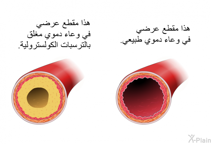 هذا مقطع عرضي في وعاء دموي طبيعي. هذا مقطع عرضي في وعاء دموي مغلق بالترسبات الكولسترولية.