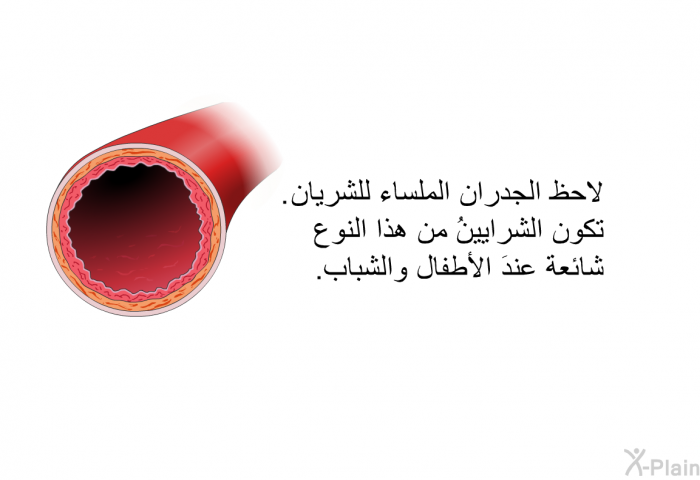 لاحظ الجدران الملساء للشَّريان. تكون الشرايينُ من هذا النوع شائعة عندَ الأطفال والشباب.