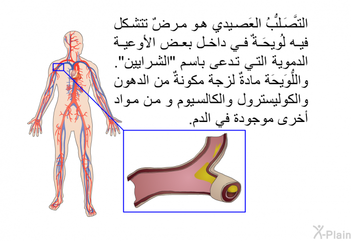 التَّصَلُّبُ<B> </B>العَصيدي هو مرضٌ تتشكل فيه لُويحَةٌ في داخل بعض الأوعية الدموية التي تدعى باسم "الشرايين". واللُّوَيحَة مادةٌ لزجة مكونةٌ من الدهون والكوليسترول والكالسيوم و من مواد أخرى موجودة في الدم.