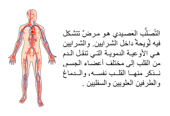 التَّصَلُّب<B> </B>العَصيدي هو مرضٌ تتشكل فيه لُويحةٌ داخل الشرايين. والشرايين هي الأوعية الدموية التي تنقل الدم من القلب إلى مختلف أعضاء الجسم، نذكر منها القلب نفسه، والدماغ والطرفين العلويين والسفليين .