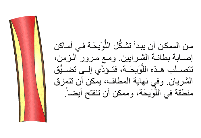 من الممكن أن يبدأ تشكُّل اللُّوَيحَة في أماكن إصابة بطانة الشرايين. ومع مرور الزمن، تتصلب هذه اللُّوَيحَة، فتؤدِّي إلى تضيُّق الشريان. وفي نهاية المطاف، يمكن أن تتمزق منطقة في اللُّوَيحَة، وممكن أن تنفتح أيضاً.