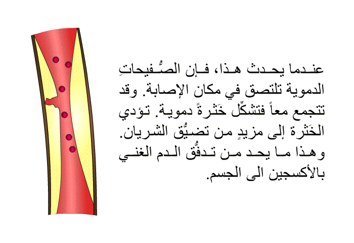 عندما يحدث هذا، فإن الصُّفيحاتِ الدموية تلتصق في مكان الإصابة. وقد تتجمع معاً فتشكِّل خَثرةً دموية. تؤدي الخَثرة إلى مزيدٍ من تضيُّق الشريان. وهذا ما يحد من تدفُّق الدم الغني بالأكسجين الى الجسم.