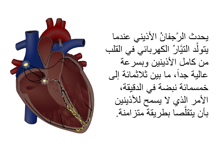 يحدث الرَّجفانُ الأذيني عندما يتولَّد التيَّارُ الكهربائي في القلب من كامل الأذينين وبسرعة عالية جداً، ما بين ثلاثمائة إلى خمسمائة نبضة في الدقيقة، الأمر الذي لا يسمح للأذينين بأن يتقلَّصا بطريقة متزامنة.