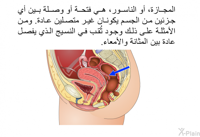المجازة، أو الناسور، هي فتحة أو وصلة بين أي جزئين من الجسم يكونان غير متصلين عادة. ومن الأمثلة على ذلك وجود ثُقب في النسيج الذي يفصل عادة بين المثانة والأمعاء.