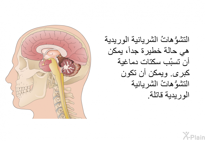 التشوُّهاتُ الشريانية الوريدية هي حالة خطيرة جداً، يمكن أن تسبِّب سكتات دماغية كبرى. ويمكن أن تكون التشوُّهاتُ الشريانية الوريدية قاتلة.