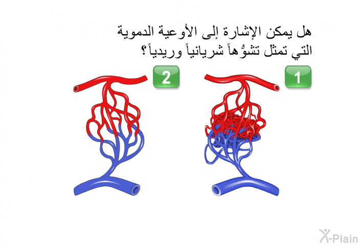 هل يمكن الإشارة إلى الأوعية الدموية التي تمثِّل تشوُّهاً شريانياً وريدياً؟