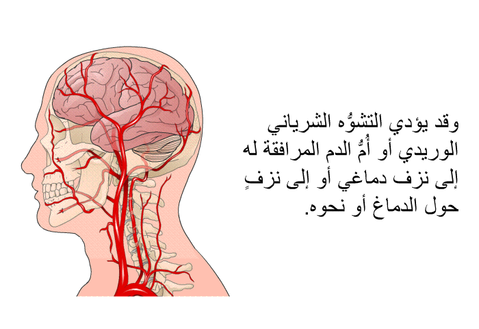 وقد يؤدي التشوُّه الشرياني الوريدي أو أُمُّ الدم المرافقة له إلى نزف دماغي أو إلى نزفٍ حول الدماغ أو نحوه.