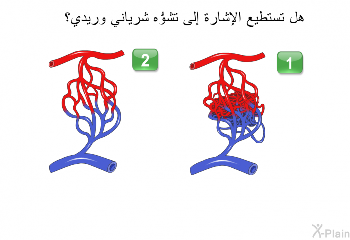 هل تستطيع الإشارة إلى تشوُّه شرياني وريدي؟
