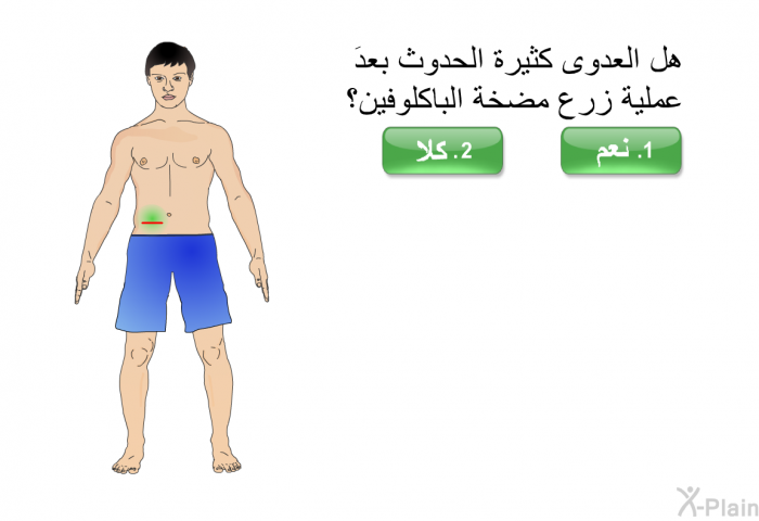 هل العدوى كثيرة الحدوث بعدَ عملية زرع مضخة الباكلوفين؟