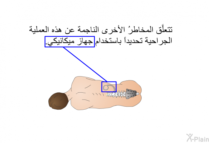 تتعلَّق المخاطرُ الأخرى الناجمة عن هذه العملية الجراحية تحديداً باستخدام جهاز ميكانيكي.
