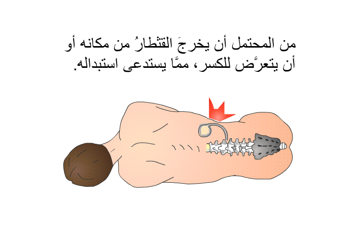 من المحتمل أن يخرجَ القثطارُ من مكانه أو أن يتعرَّض للكسر، ممَّا يستدعى استبدالَه.