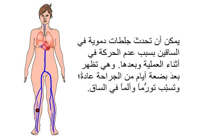 يمكن أن تحدثَ جلطات دموية في الساقين بسبب عدم الحركة في أثناء العملية وبعدها. وهي تظهر بعدَ بضعة أيام من الجراحة عادةً؛ وتسبِّب تورُّماً وألماً في الساق.