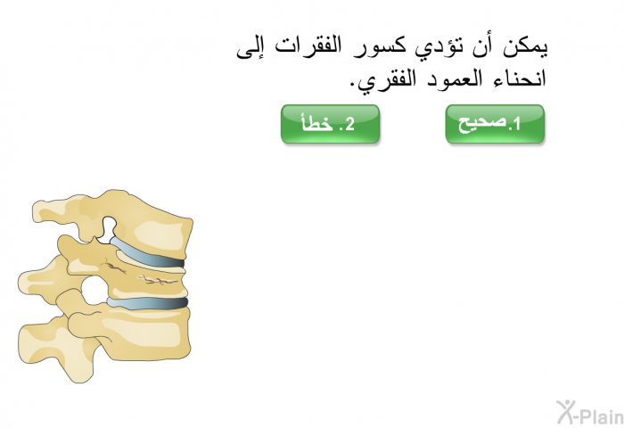 يمكن أن تؤدي كسور الفقرات إلى انحناء العمود الفقري.