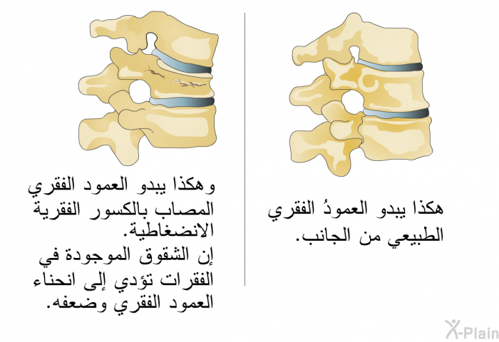 هكذا يبدو العمودُ الفقري الطبيعي من الجانب. وهكذا يبدو العمود الفقري المصاب بالكسور الفقرية الانضغاطية. إن الشقوق الموجودة في الفقرات تؤدي إلى انحناء العمود الفقري وضعفه.