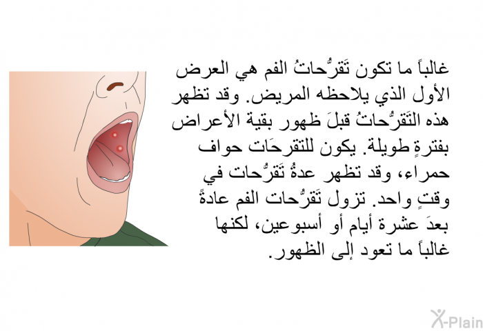 غالباً ما تكون تَقرُّحاتُ الفم هي العرض الأول الذي يلاحظه المريض. وقد تظهر هذه التَقرُّحاتُ قبلَ ظهور بقية الأعراض بفترةٍ طويلة. يكون للتَقرُّحات حواف حمراء، وقد تظهر عدةُ تَقرُّحات في وقتٍ واحد. تزول تَقرُّحات الفم عادةً بعدَ عشرة أيامٍ أو أسبوعين، لكنها غالباً ما تعود إلى الظهور.