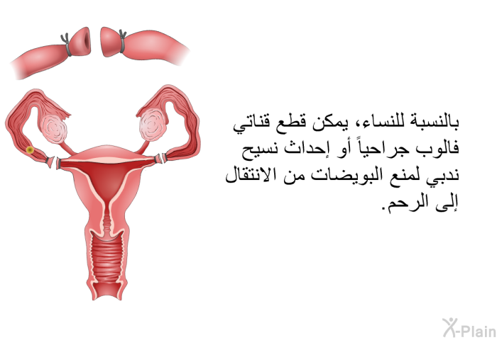بالنسبة للنساء، يمكن قطع قناتي فالوب جراحياً أو إحداث نسيح ندبي لمنع البويضات من الانتقال إلى الرحم.