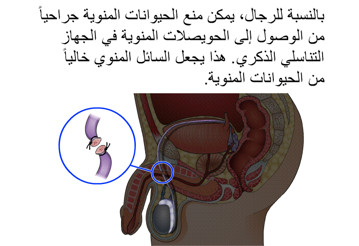 بالنسبة للرجال، يمكن منع الحيوانات المنوية جراحياً من الوصول إلى الحويصلات المنوية في الجهاز التناسلي الذكري. هذا يجعل السائل المنوي خالياً من الحيوانات المنوية.