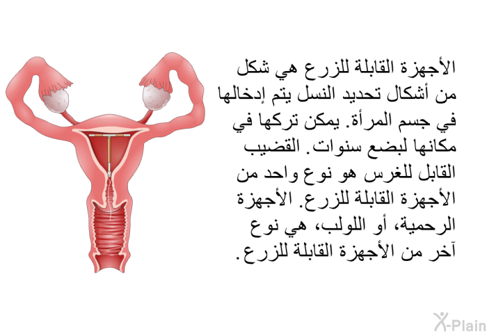 الأجهزة القابلة للزرع هي شكل من أشكال تحديد النسل يتم إدخالها في جسم المرأة. يمكن تركها في مكانها لبضع سنوات. القضيب القابل للغرس هو نوع واحد من الأجهزة القابلة للزرع. الأجهزة الرحمية، أو اللولب، هي نوع آخر من الأجهزة القابلة للزرع.