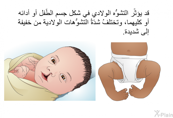 قد يؤثّر التشوُّه الولادي في شكل جسم الطّفل أو أدائه أو كليهما، وتختلفُ شدّةُ التشوُّهات الولادية من خفيفة إلى شديدة.