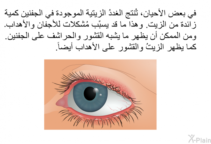 في بعض الأحيان، تُنتج الغددُ الزيتية الموجودة في الجفنين كمية زائدة من الزيت. وهذا ما قد يسبِّب مُشكلات للأجفان والأهداب. ومن الممكن أن يظهر ما يشبه القشور والحراشف على الجفنين. كما يظهر الزيتُ والقشور على الأهداب أيضاً.