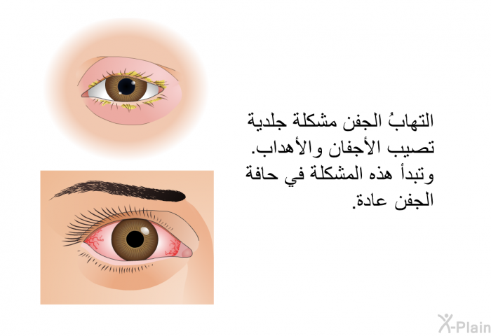 التهابُ الجفن مشكلة جلدية تصيب الأجفان والأهداب. وتبدأ هذه المشكلة في حافة الجفن عادة.