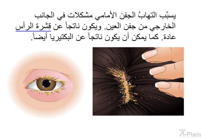 يسبِّب التهابُ الجفن الأمامي مشكلات في الجانب الخارجي من جفن العين. ويكون ناتجاً عن قِشرة الرأس عادة. كما يمكن أن يكون ناتجاً عن البكتيريا أيضاً.