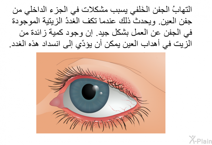 التهابُ الجفن الخَلفي يسبب مشكلات في الجزء الداخلي من جفن العين. ويحدث ذلك عندما تكف الغددُ الزيتية الموجودة في الجفن عن العمل بشكل جيد. إن وجود كمية زائدة من الزيت في أهداب العين يمكن أن يؤدِّي إلى انسداد هذه الغدد.