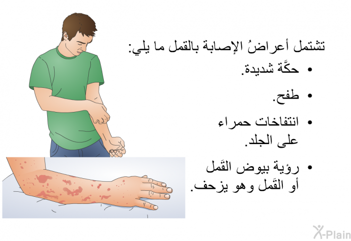 تشتمل أعراضُ الإصابة بالقمل ما يلي:  حكَّة شديدة. طفح. انتفاخات حمراء على الجلد. رؤية بيوض القَمل أو القَمل وهو يزحف.