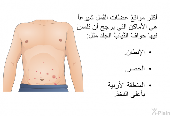 أكثر مواقعُ عضَّات القَمل شيوعاً هي الأماكن التي يرجح أن تلمسَ فيها حوافّ الثيابُ الجلدَ مثل:  الإبطان. الخصر. المنطقة الأربية بأعلى الفخذ.