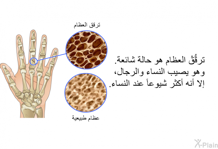 ترقُّقُ العظام هو حالة شائعة. وهو يصيب النساء والرجال، إلا أنه أكثر شيوعاً عند النساء.