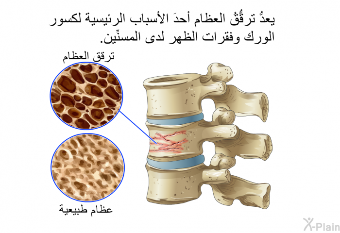 يعدُّ ترقُّقُ العظام أحدَ الأسباب الرئيسية لكسور الورك وفقرات الظهر لدى المسنِّين.